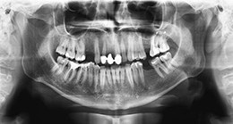 pano xray